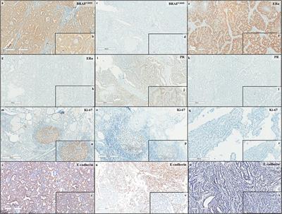 Molecular Predictors for Advanced Papillary Thyroid Carcinoma Recurrence